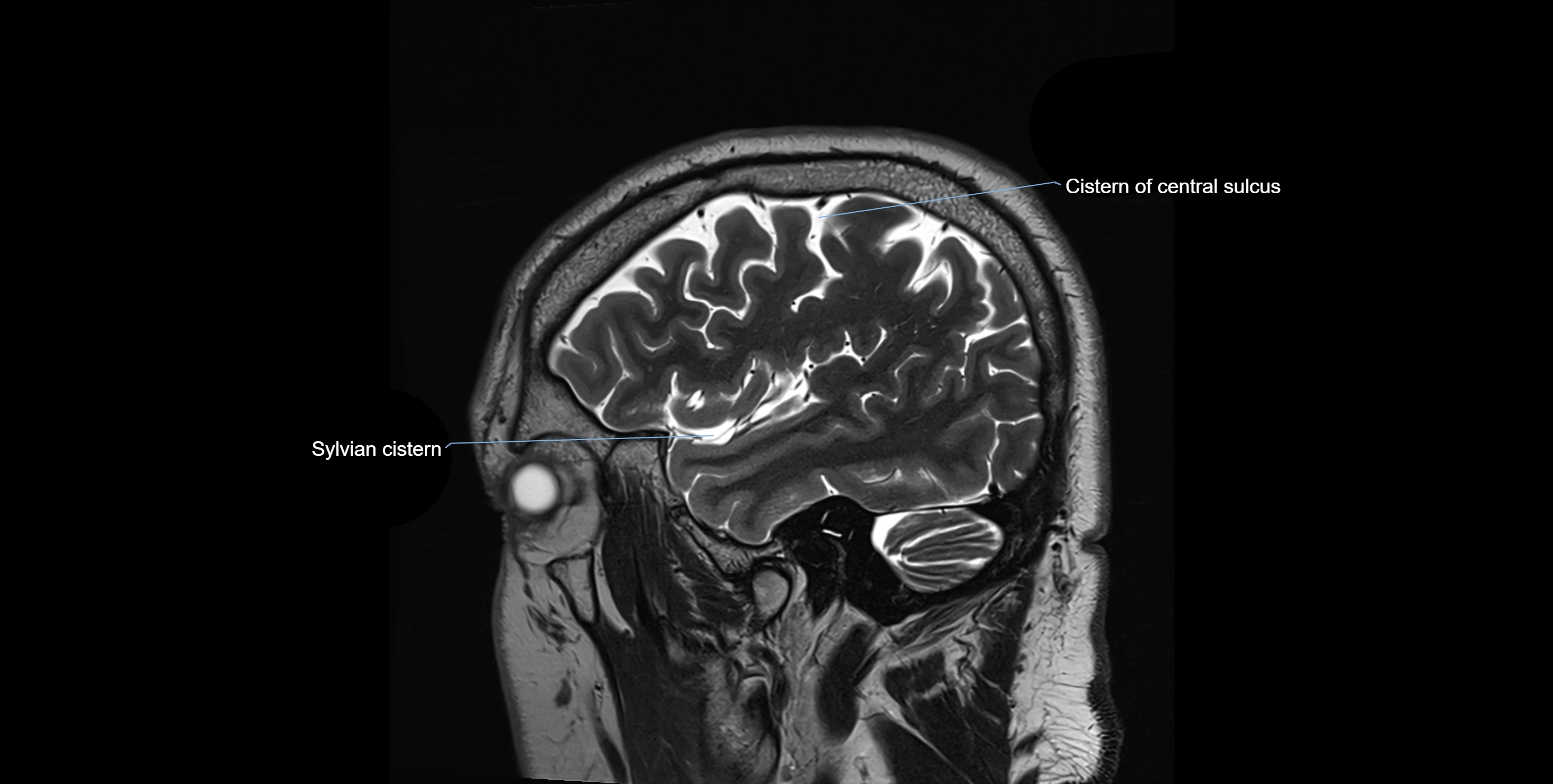 Brain cisterns  and ventricles sagittal anatomy 3T MRI image-img-00001-00009.webp